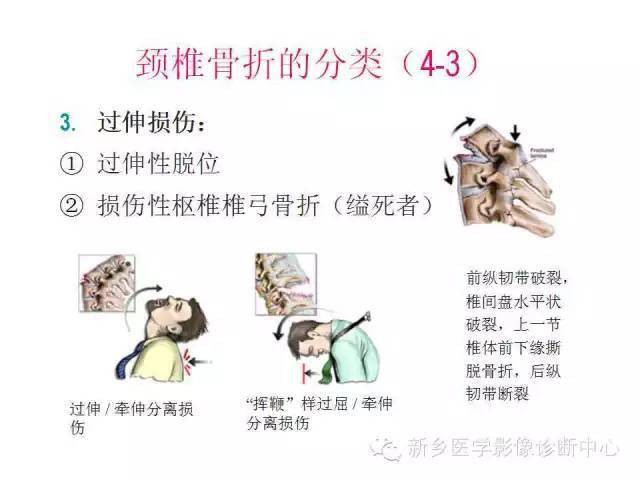 脊柱骨折是这样分型的,细致到疯狂