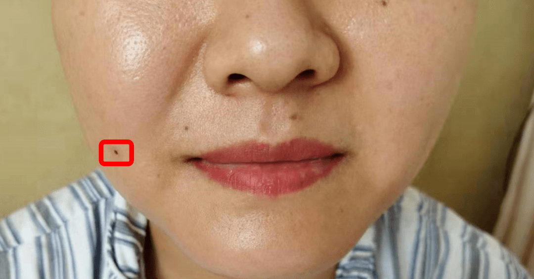 华科在线智能机器人引导下球囊压迫术治疗三叉神经痛三例