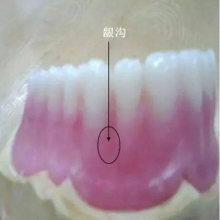 牙龈龈颊沟在哪里图片图片