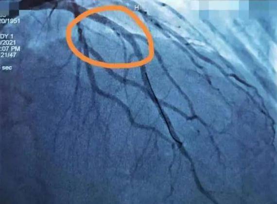 鲁婷婷|“杠飘，胡啦！”老大爷一激动突发心梗…