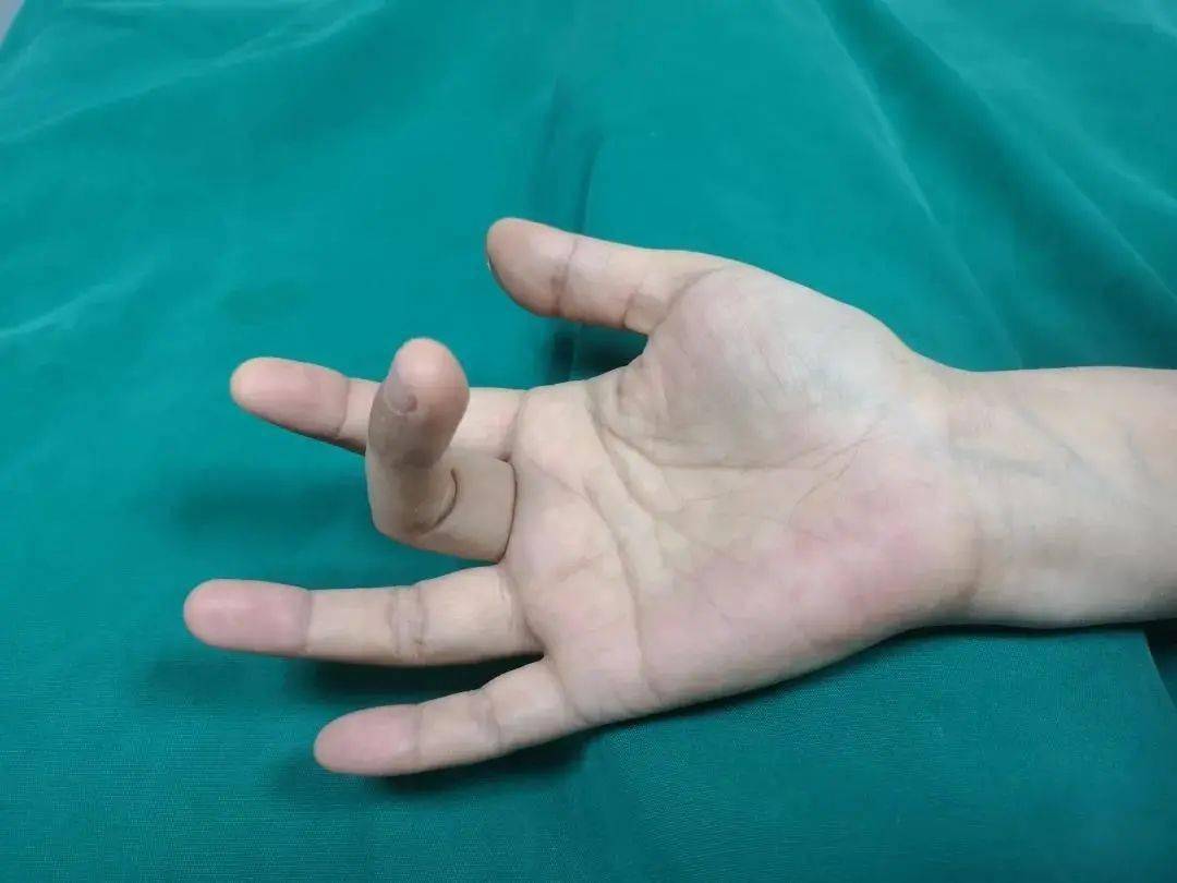 整日耍手机,小心这个病_治疗