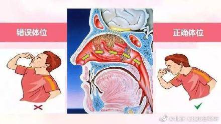 脑门|鼻出血该怎么办？