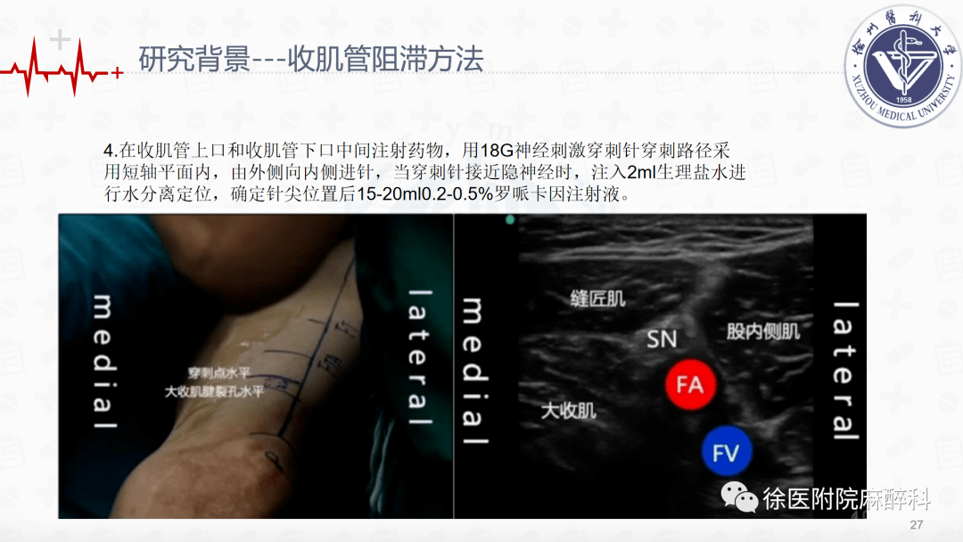 全膝关节置换术中局部浸润麻醉和连续收肌管阻滞结合ipack神经阻滞的