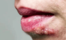 嘴角|小小疱疹，竟夺走了多名孩子的生命