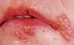 嘴角|小小疱疹，竟夺走了多名孩子的生命