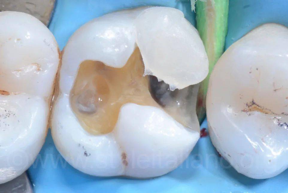 牙医学堂后牙邻面吻合龋的直接修复