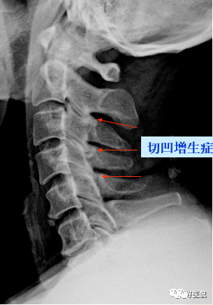 颈椎病解剖经典影像_关节