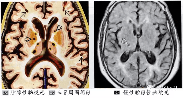 b-大腦後動脈的丘腦膝狀體動脈;a-大腦中動脈豆紋動脈分支;charles