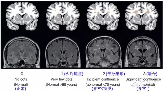 脑白质区内mri斑点状异常信号解读