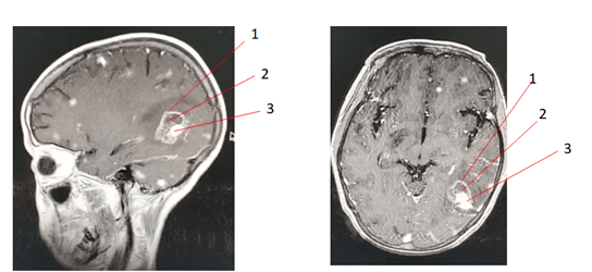 本患ct提示双额叶,左枕叶,双侧基底节区可见片状低密度影,左枕叶病灶