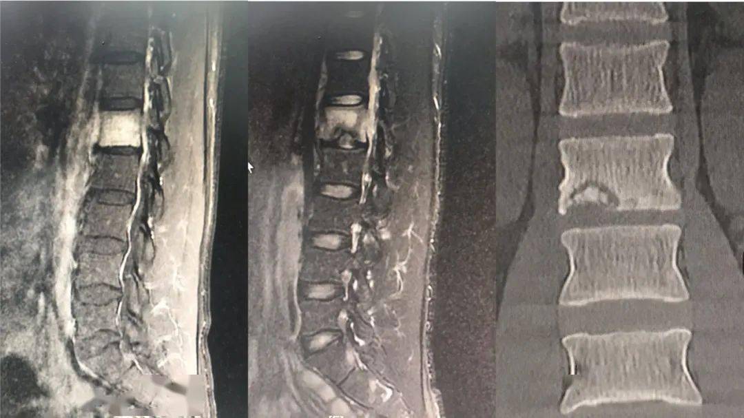 談核不再色變醫院首例椎間孔鏡治療腰椎結核微創術取得圓滿成功