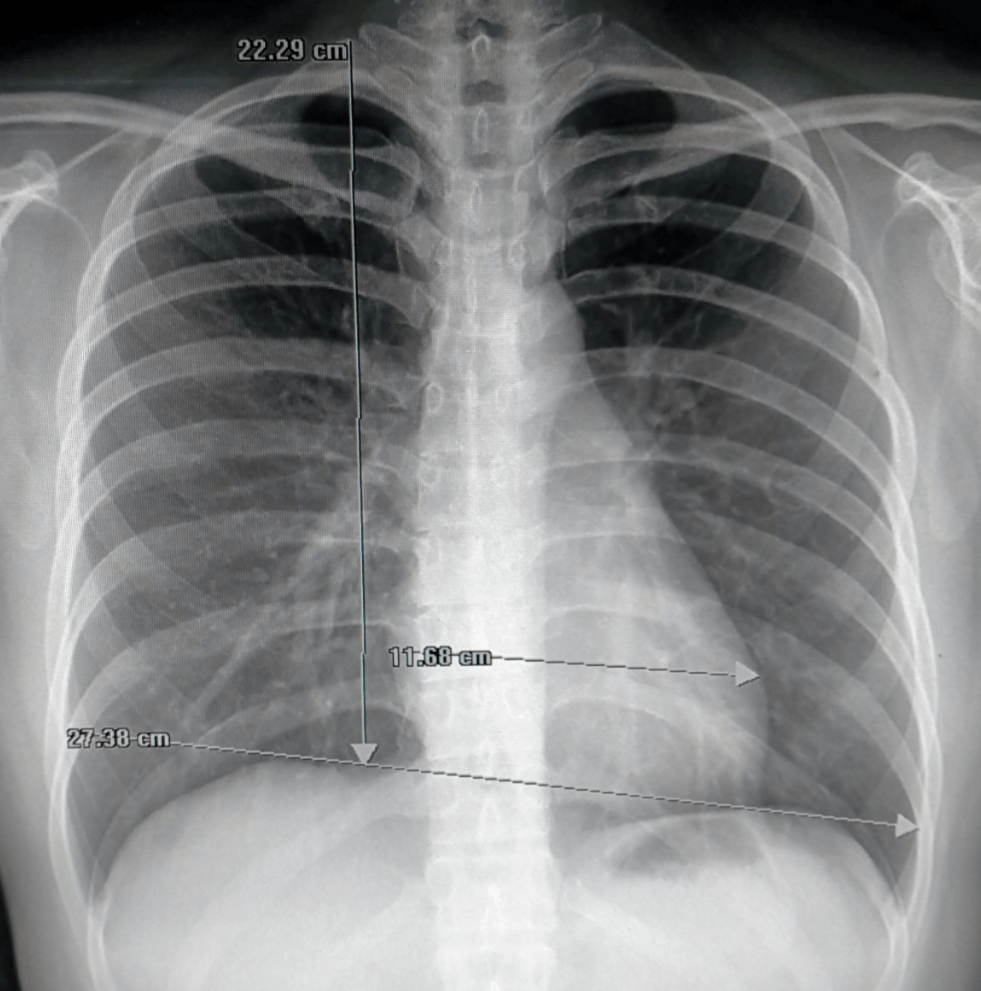 正常肺片x光片图片