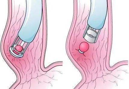 什么叫内痔疮 d7852fb170c8477598dff6c81219890f.jpeg