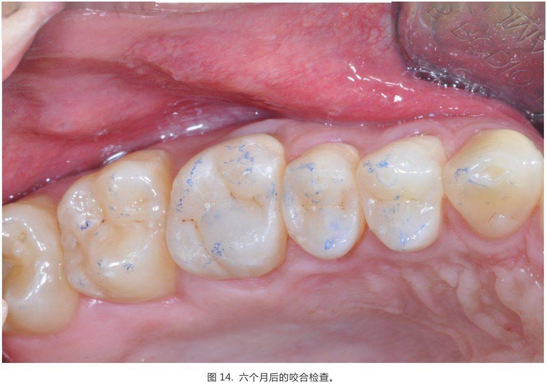 10个后牙直接充填注意点