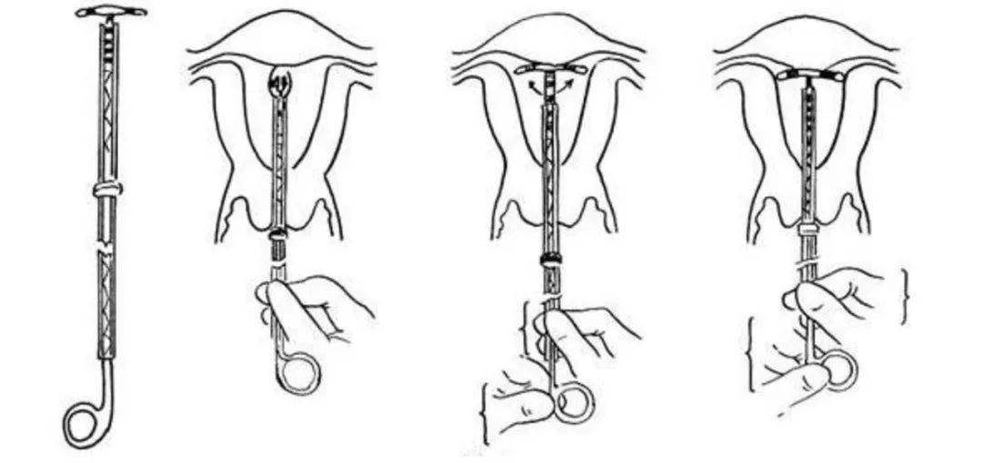 被遗忘在女性体内的「节育环,该取出来了._子宫