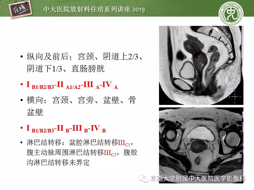 子宮詳細解剖及磁共振信號分析