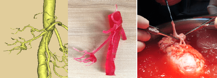 团队|修肾、挪窝、回植，中山一肾团队用一个切口完成自体肾移植