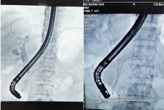 外科风云北碚区中医院外一科成功开展不开刀的手术ercp术