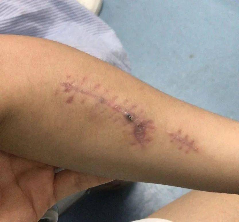 抚州一5岁女童演出时手臂被割伤缝了30多针