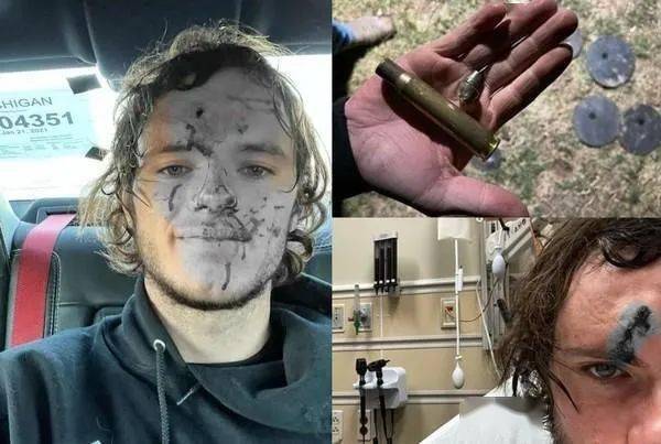 万幸的是子弹没有伤到头骨,他在接受治疗后没有大碍.