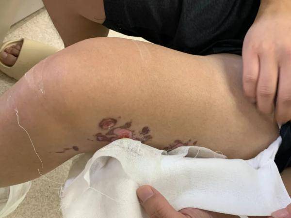 干冰|男子扭伤后用它冷敷，皮肤严重冻伤发紫！很多人都不知道...