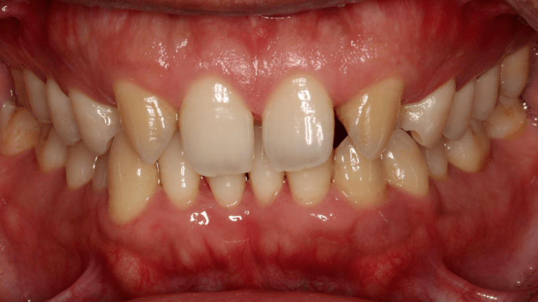 病例前牙烤瓷贴面修复一例