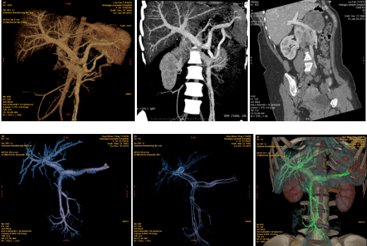 7.門脈,肝靜脈及下腔靜脈ctv成像:6.肺動脈cta:5.