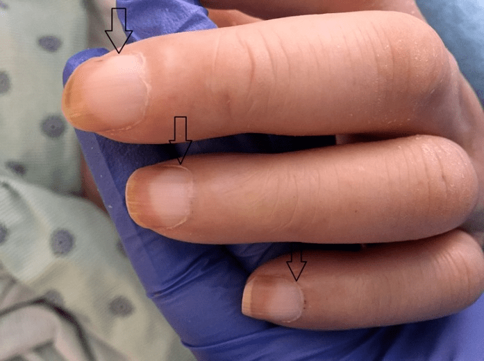 预警|你的肾好不好,看指甲就知道?医生:长这样的要警惕!