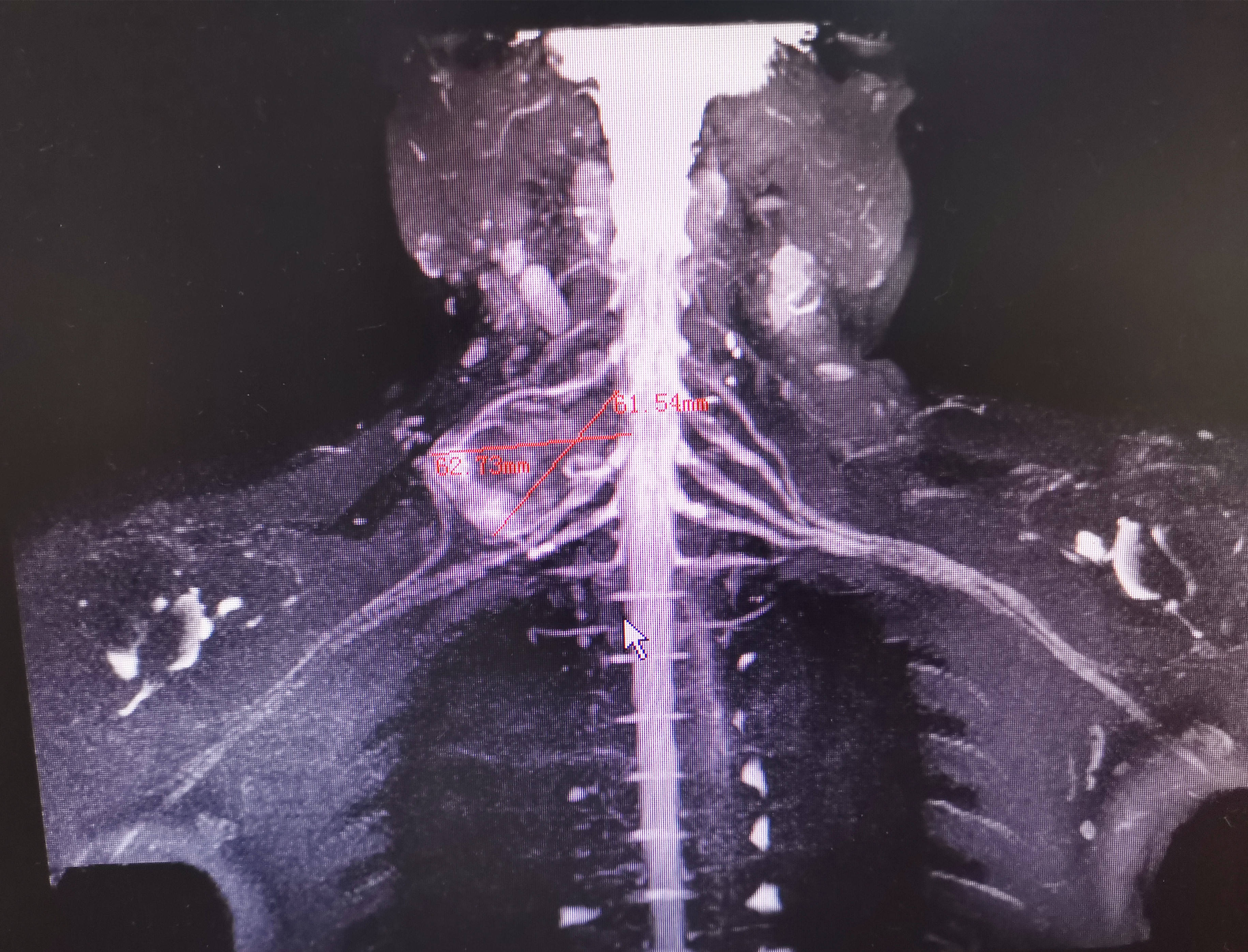 颈部神经鞘瘤位置图片图片