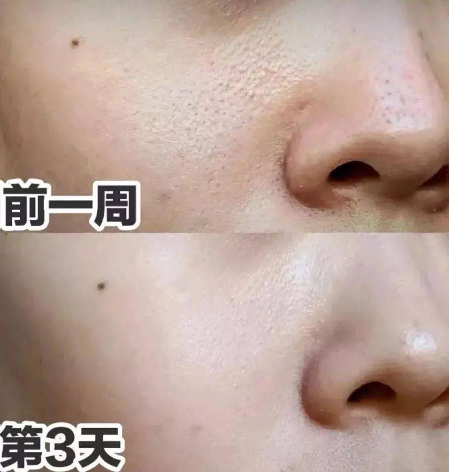 油脂|新西兰百年历史“污垢吸铁石”，15分钟告别黑头、粉刺、闭口
