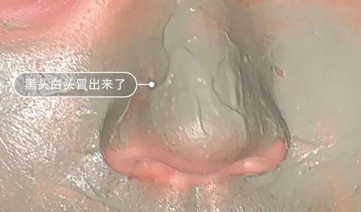 油脂|新西兰百年历史“污垢吸铁石”，15分钟告别黑头、粉刺、闭口