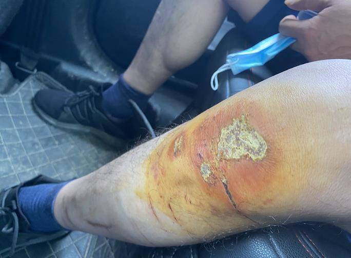 抗洪战士受伤的腿图片