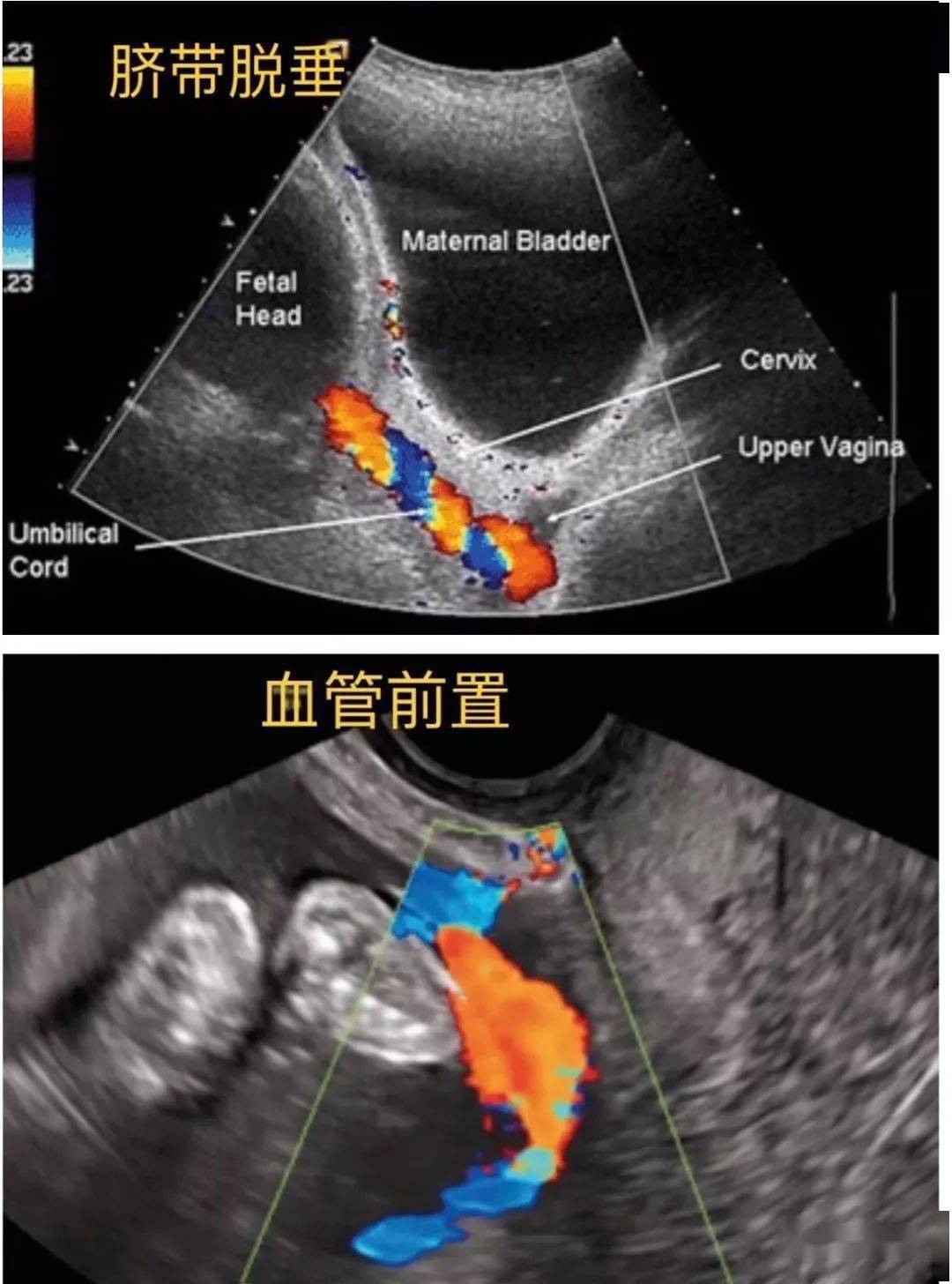 再談血管前置和臍帶脫垂