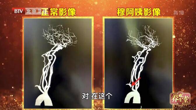 血管|特殊脑中风危机，锁骨下动脉狭窄