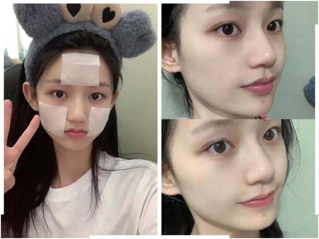 2块钱刷一次酸脸上"小疙瘩"竟被吞了 !