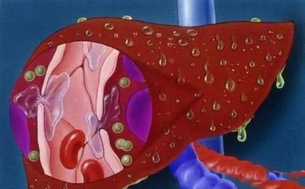 治疗|科普 | 从乙肝到肝硬化,需要多久?