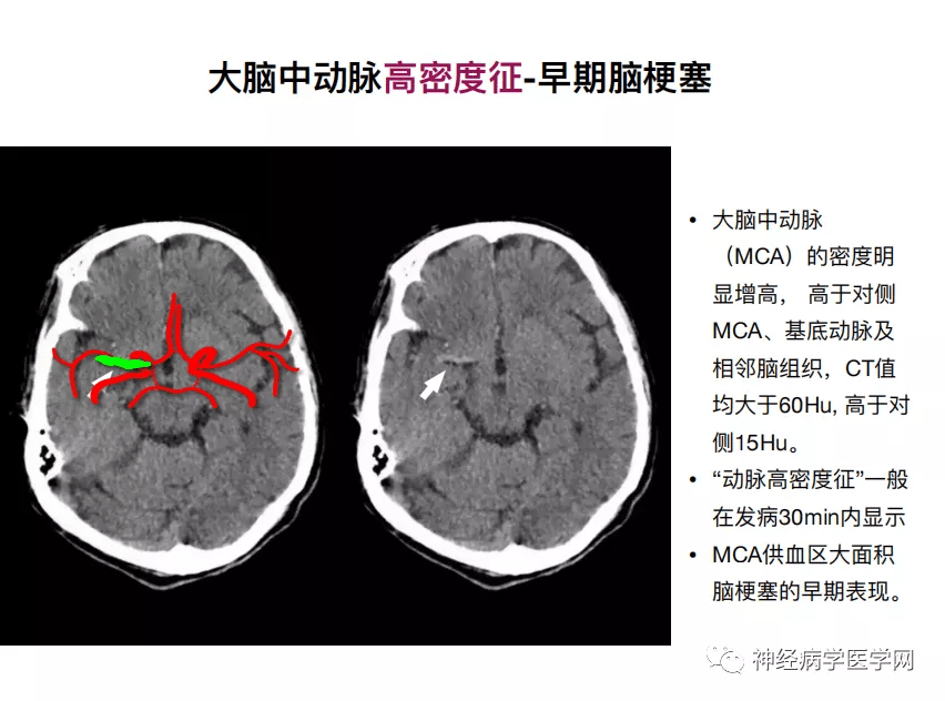 颅脑疾病ct影像特异征象ct篇