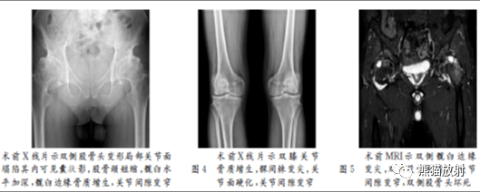 x線診斷要點丨軟骨發育不全脊柱骨骺發育不良半肢骨骺發育異常