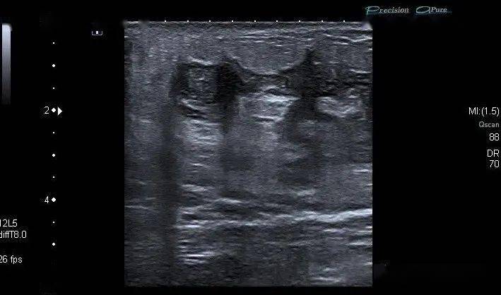 典型病例61肉芽肿性乳腺炎_疾病