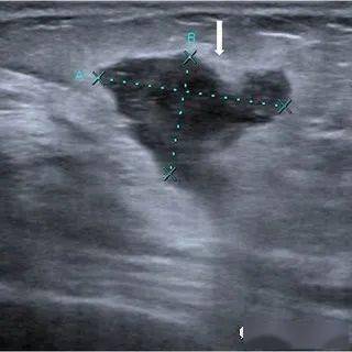 典型病例61肉芽肿性乳腺炎_疾病