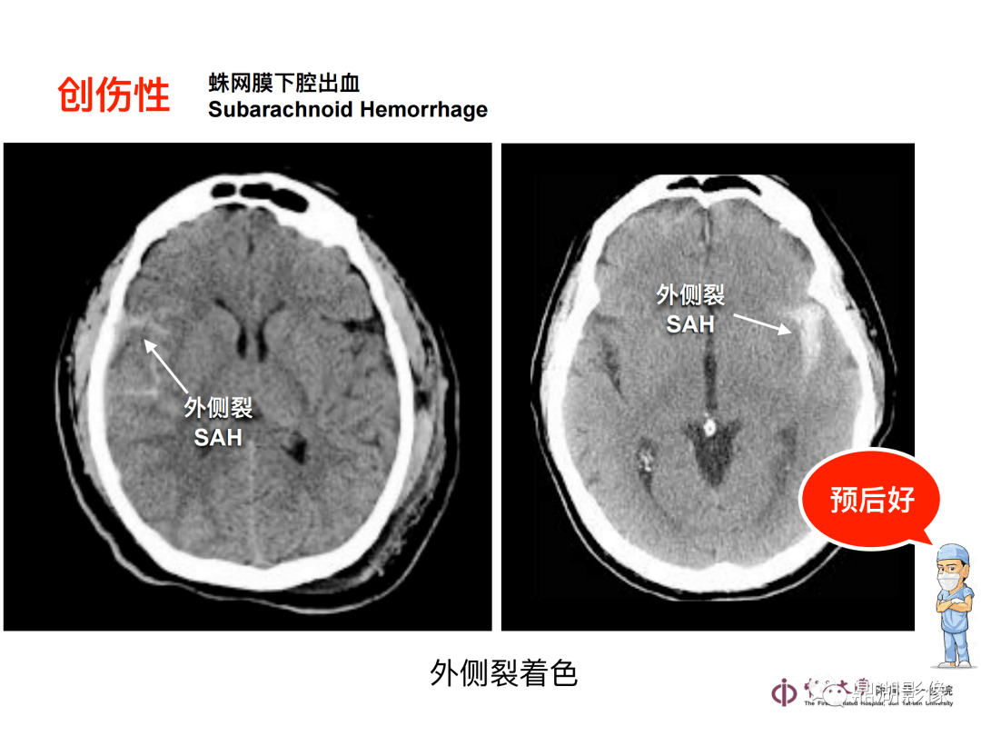 超實用急診頭顱ct3b閱片法