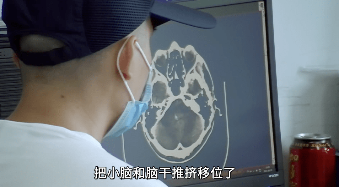 睡眠|27岁脑瘤,26岁脑出血......年轻人,别再熬夜了!