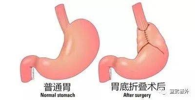 生活|有一种“咳嗽”，止咳药无效！