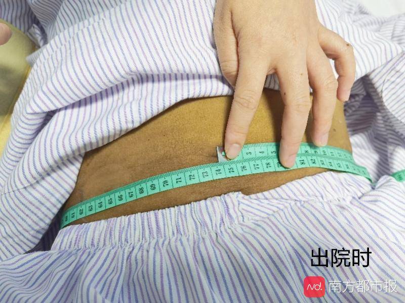 大肚子|心脏瓣膜病变竟催生出个超级大肚腩，心衰也能引起腹部膨胀