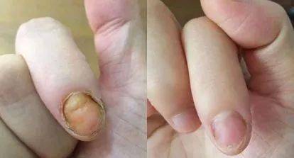 德国科技生物膜,涂抹一下,7天重获亮甲,20年顽固灰指甲也能救!