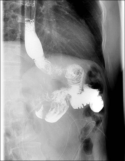 陈医生|福州张先生长期胃反酸，竟还引发癌症…