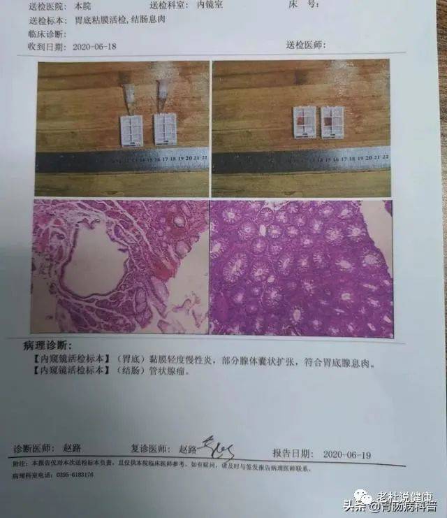 肠息肉切除后 3年不复查 便血腹痛再来查 结果是晚期肠癌 检查