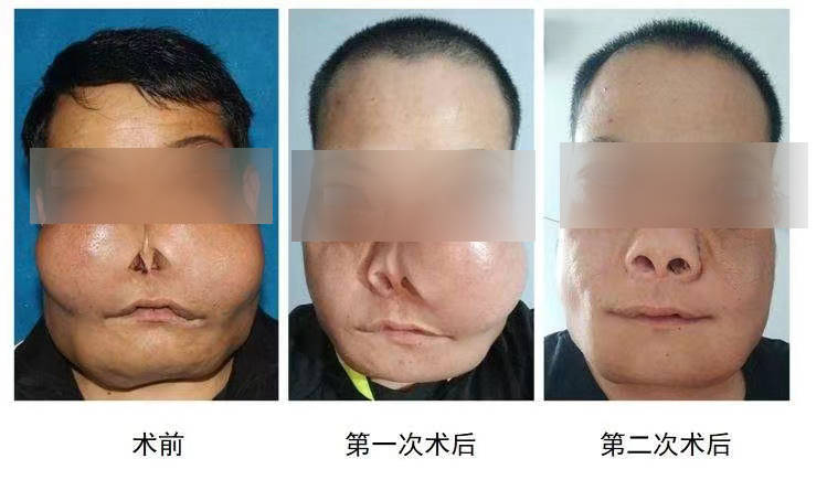 颌面|29岁男子长“河马脸”被当怪物，两次手术“改写人生”