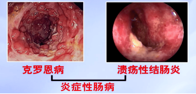 炎症性肠病药物治疗最全总结建议收藏