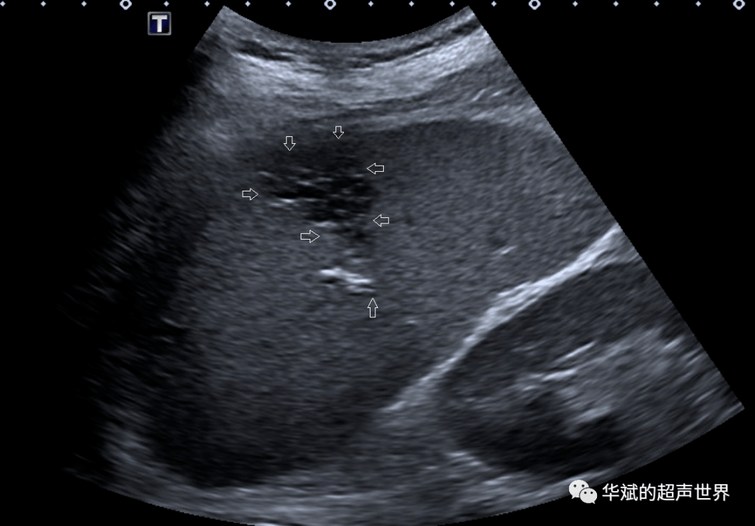 脾静脉超声图图片